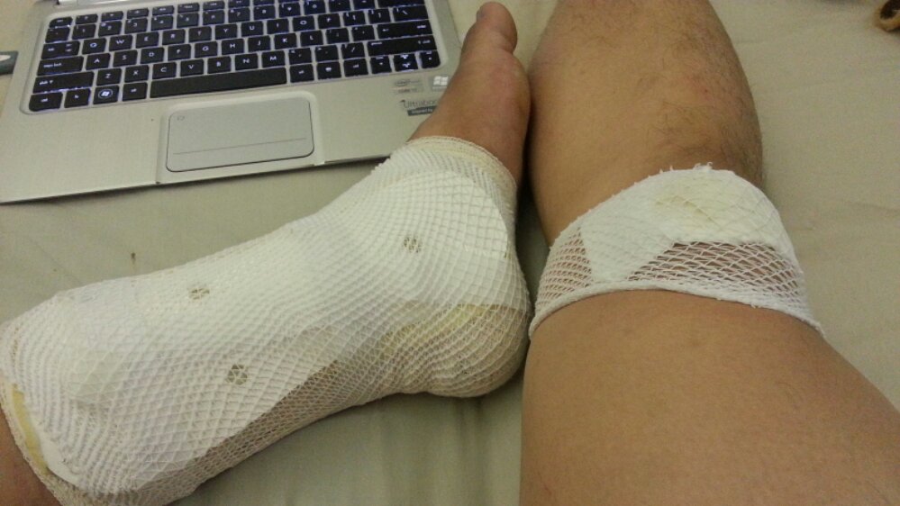Bread Rack Injuries Run for Food: First injury | zen online journal